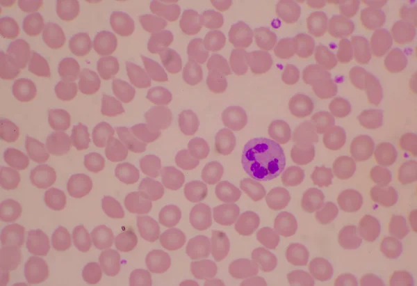 Белые Клетки Крови Фоне Нормальных Эритроцитов — стоковое фото