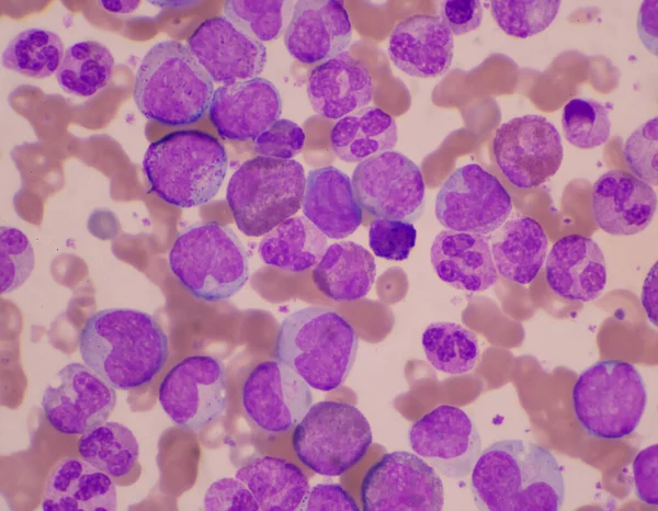 红血球背景上的混合阶段白血球 白血病概念 — 图库照片