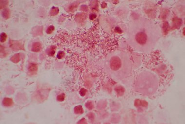 İdrar örneğinde beyaz kan hücreleri olan orta dereceli dırdırcı bakil..