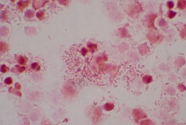 İdrar örneğinde beyaz kan hücreleri olan orta dereceli dırdırcı bakil..