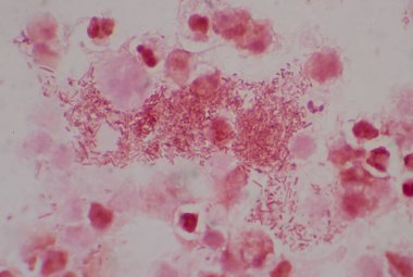 İdrar örneğinde beyaz kan hücreleri olan orta dereceli dırdırcı bakil..