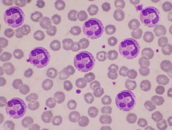 Neutrófilo Com Fagocitose Vacular Nos Glóbulos Vermelhos — Fotografia de Stock