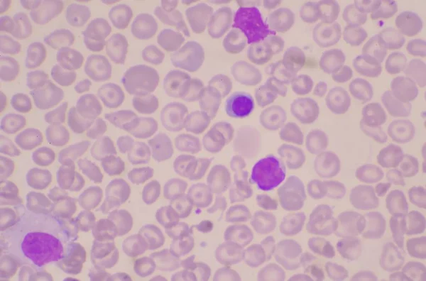 血液涂片中的核红血球 Nrc — 图库照片
