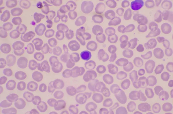 Cellule Rosse Nucleate Nrc Nello Striscio Sangue — Foto Stock