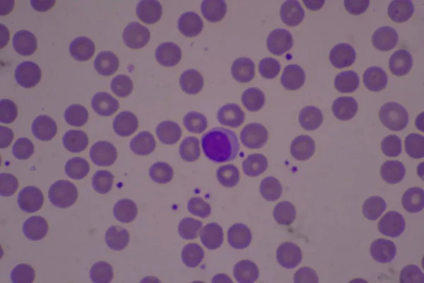 Toereikende Trombocytenconcentratie Bloeduitstrijkjes Volledig Bloedbeeld — Stockfoto