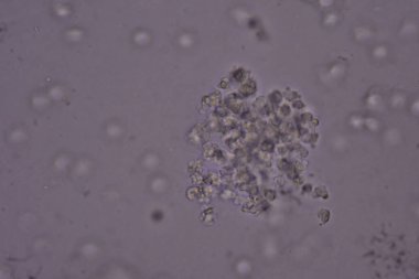 İdrarda biriken beyaz kan hücresi sistit ezmesi..