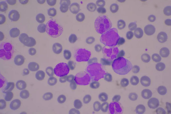 Onrijpe Rijpe Witte Bloedcellen Gesegmenteerde Neutrofiel Blastaire Cellen Myelocyt Metamyelocyt — Stockfoto