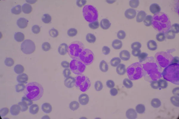 성숙되지 백혈구 Segsated Neutrophil Blast Cell Myelocyte Metamyelocyte Band Form — 스톡 사진