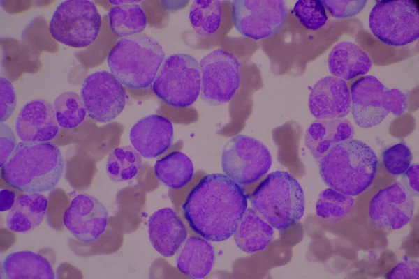 Immature Mature White Blood Cells Segmented Neutrophil Blast Cells Myelocyte — Stock Photo, Image