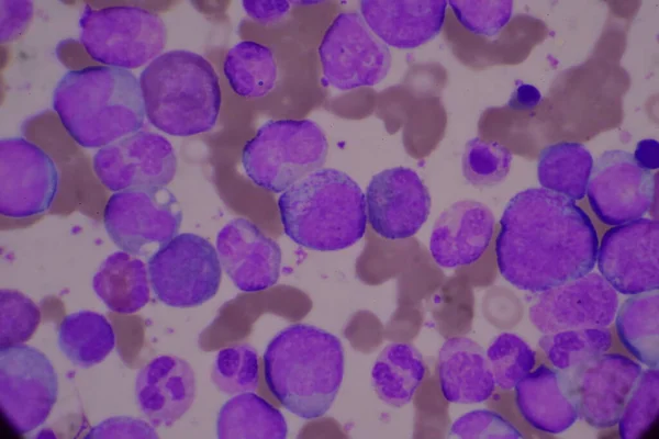 Omogna Och Mogna Vita Blodkroppar Segmenterad Neutrofil Blastceller Myelocyt Metamyelocyt — Stockfoto