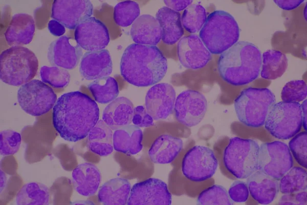 성숙되지 백혈구 Segsated Neutrophil Blast Cell Myelocyte Metamyelocyte Band Form — 스톡 사진