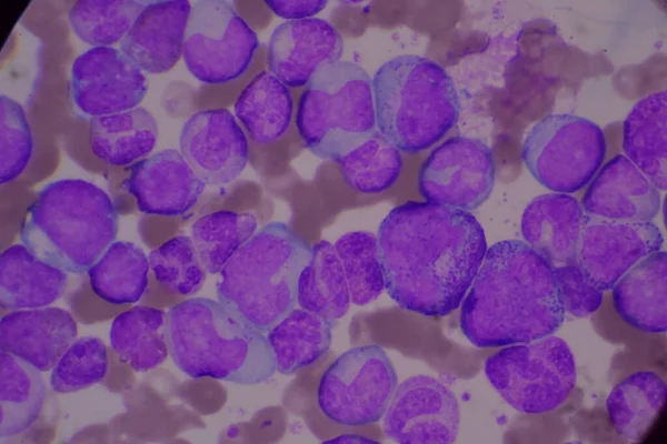 성숙되지 백혈구 Segsated Neutrophil Blast Cell Myelocyte Metamyelocyte Band Form — 스톡 사진