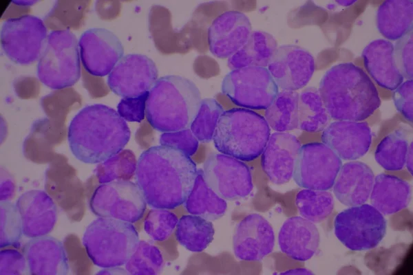 未成熟で成熟した白血球 セグメント化好中球 爆風細胞骨髄細胞 Metamyelloce バンドフォーム — ストック写真