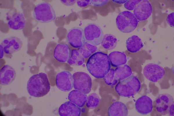 Omogna Och Mogna Vita Blodkroppar Segmenterad Neutrofil Blastceller Myelocyt Metamyelocyt — Stockfoto