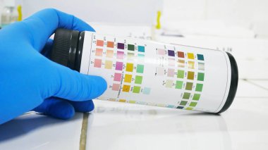 Laboratuvarda Kimyasal Parçacık testi idrar analizi.