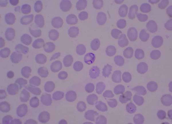 Vér Parazita Gyűrű Formájában Malária Fertőzött Vörös Vérsejtek Vastag Film — Stock Fotó