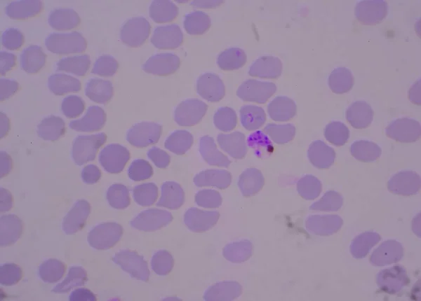 Anello Parassita Del Sangue Forma Malaria Infetti Globuli Rossi — Foto Stock