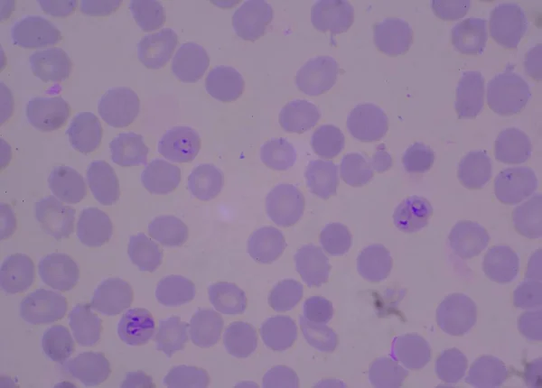 Blood Parasite Ring Form Malaria Infected Red Blood Cells Thick — Stock Photo, Image