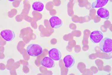 Lymphoblast