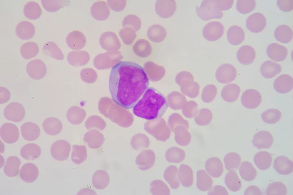 Lymphoblast — Stock Photo, Image