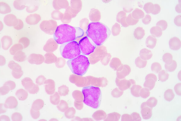 Lymphoblast
