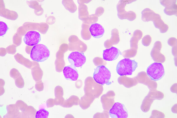 Lymphoblast
