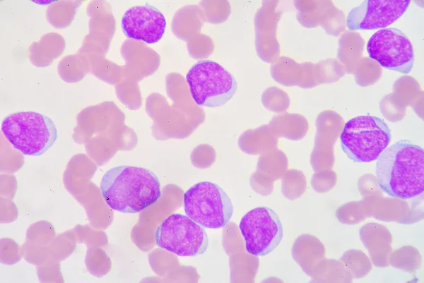 Lymphoblast — Stok fotoğraf