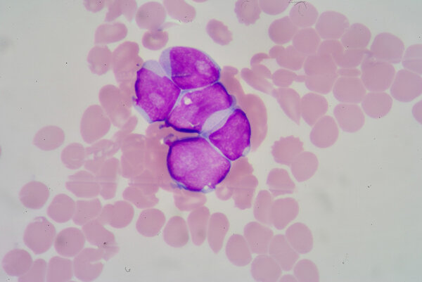 Lymphoblast