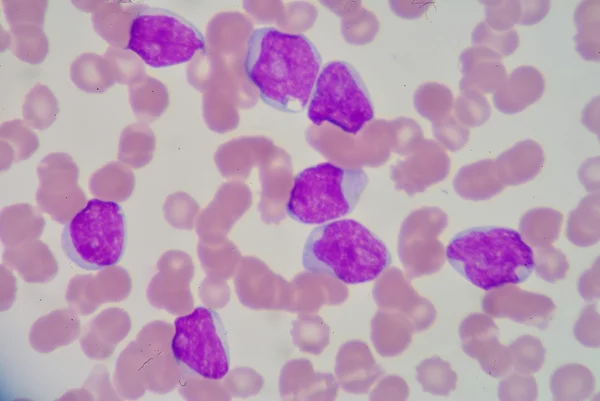 Lymphoblast — Stock Photo, Image