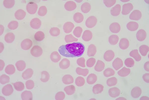 Atypical lymphocyte — Stock Photo, Image