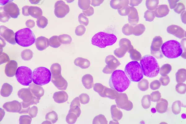 Lymphoblaste — Stockfoto