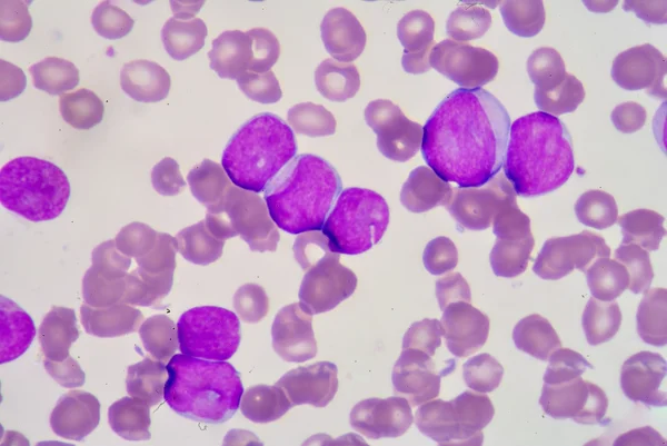 Lymphoblaste — Stockfoto