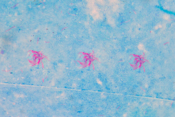 AFB позитивные