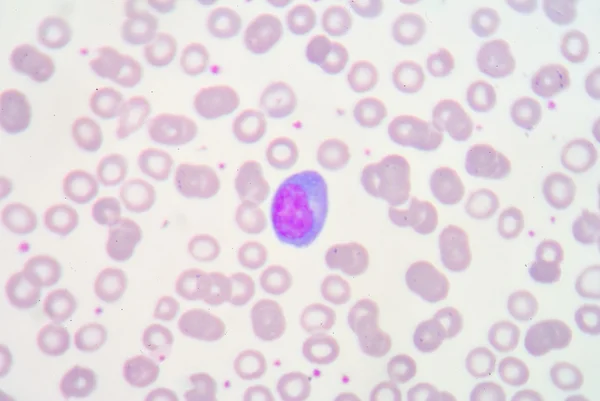 Atypical lymphocyte or Transform lymphocyte. — Stock Photo, Image