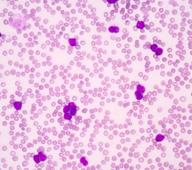 Akut myeloblastic Lösemi (Aml)