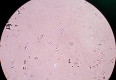 insan idrarda fosfat kristalleri üçlü.