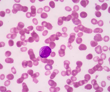 Promielocyte.A kan yayma genellikle takip testi olarak kullanılır (Cbc)