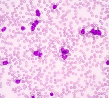 Akut myeloblastic Lösemi (Aml)