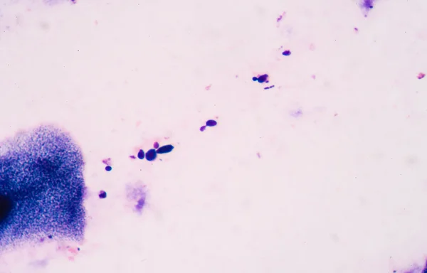 Cellule di lievito in germogliamento con pseudohyphae da sputum gram stain tes — Foto Stock