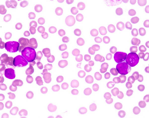 Akut myeloblastic leukemi (Aml) — Stockfoto