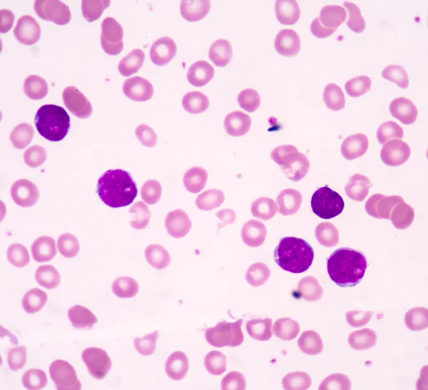 Acute lymphoblastic leukemia(ALL) — Stock Photo, Image