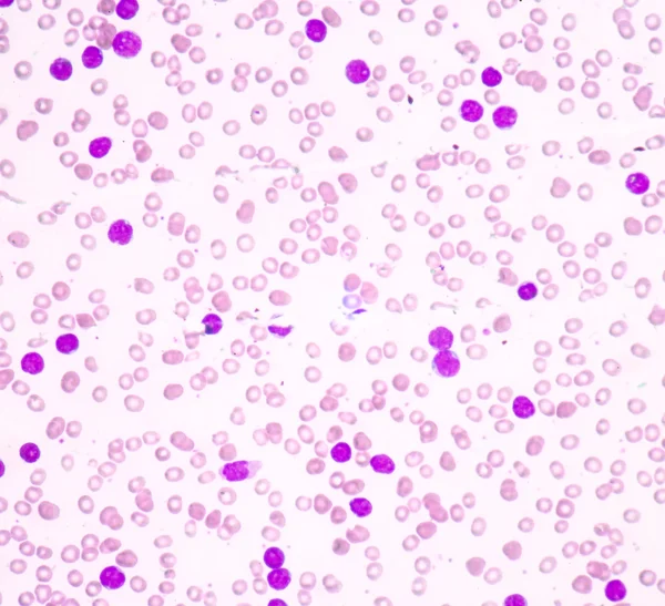 Acute lymphoblastic leukemia(ALL) — Stock Photo, Image