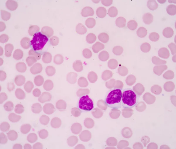 Chronic lymphocytic Leukemia(CLL) — Stock Photo, Image