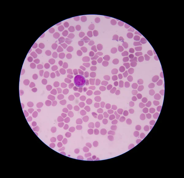 Dengue blood smear — Stock Photo, Image