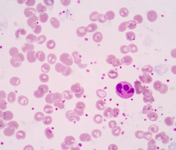 Hypersegmented neutrophil — 스톡 사진