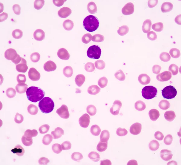 Acute lymphoblastic leukemia(ALL) — Stock Photo, Image