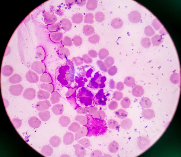 Neutrofilo anormale nello striscio di liquido pleurico . — Foto Stock