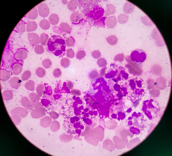 Abnormal neutrophil in pleural fluid smear. — Stock Photo, Image