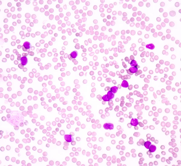 Acute myeloblastic leukemie (Aml) — Stockfoto