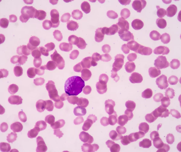 Promyelocyte.A blood smear is often used as a follow-up test (CBC) — Stock Photo, Image